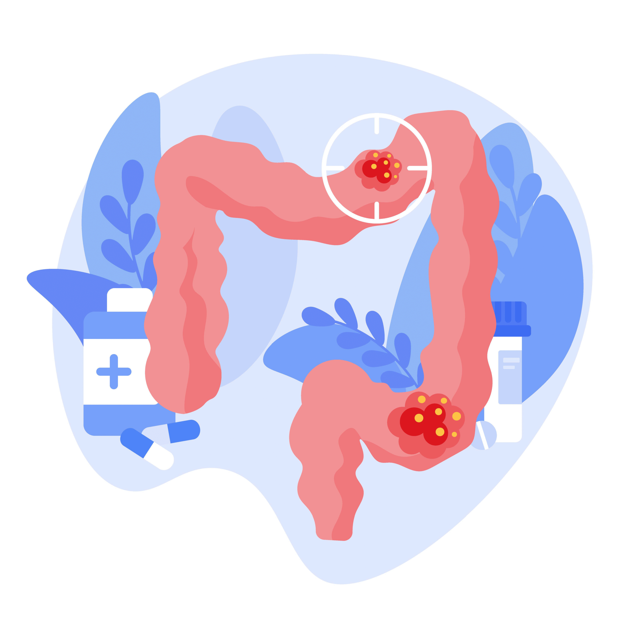 Illustration eines Dickdarms mit zwei markierten roten Wucherungen; daneben stehen Medikamentenbehälter und Kapseln.