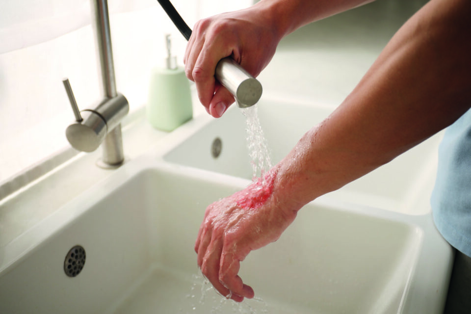 Eine Person kühlt eine gerötete Verbrennungswunde am Handrücken unter klarem Leitungswasser, um die Haut zu beruhigen.